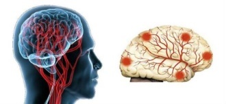 Енцефалопатія головного мозку: що це таке, лікування і наслідки захворювання