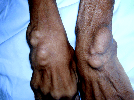 Кальциноз шкіри у людей: причини, симптоми, фото, лікування