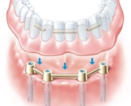 Зубні протези при повній або частковій відсутності зубів - знімні, незнімні
