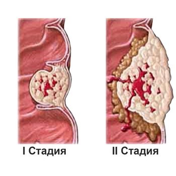 Фолікулярний рак щитовидної залози - симптоми, лікування, прогноз після операції
