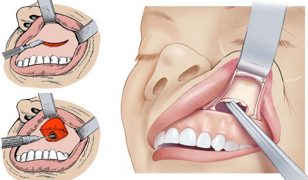 Операція при гаймориті: як роблять чистку пазух носа?