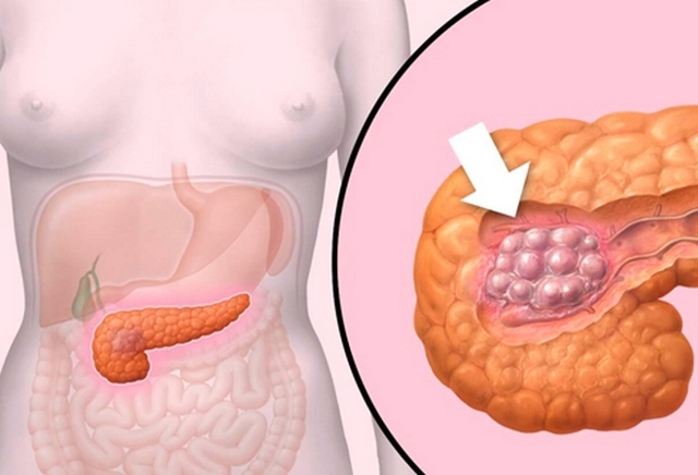 Рак підшлункової залози: симптоми, лікування, стадії раку підшлункової залози, прогнози, скільки живуть з раком підшлункової