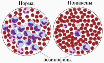 Аналіз крові на еозинофіли дитини: що це таке, як здавати, як називається, розшифровка