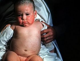 Вроджена цитомегаловірусна інфекція у новонароджених: шляхи зараження, характерні ознаки, лікування і профілактика розвитку ускладнень