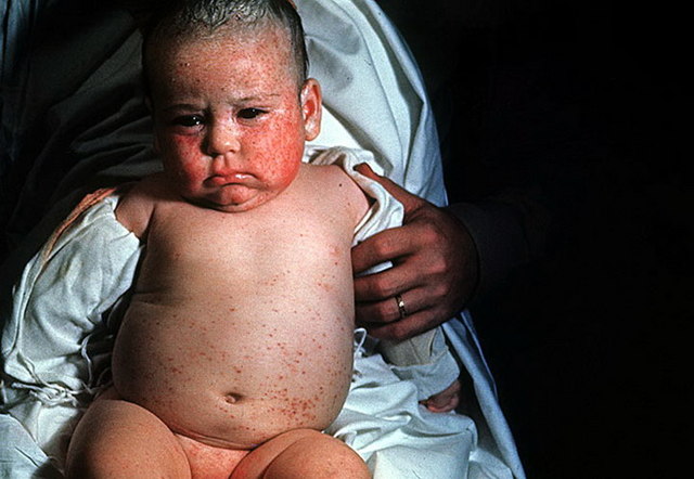 Вроджена цитомегаловірусна інфекція у новонароджених: шляхи зараження, характерні ознаки, лікування і профілактика розвитку ускладнень