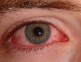 Ірит очі: причини запалення, симптоми і методи лікування у дітей та дорослих