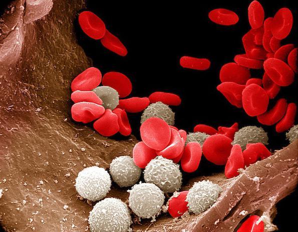 Підвищений вміст лейкоцитів в крові: основні причини