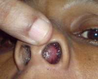 Абсцес і гематома перегородки носа: причини, симптоми і лікування захворювання
