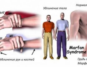Арахнодактилія, синдром Марфана, хвороба павукових пальців: причини розвитку, типові ознаки, підтримуюча терапія