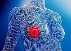 Рак молочної залози: види і симптоми, сучасні методи лікування та діагностики