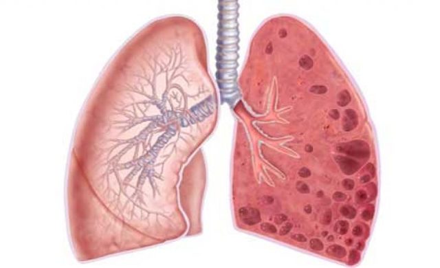 Емфізема легенів: симптоми, лікування, причини та діагностика емфіземи легенів.