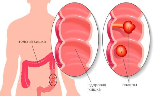 Поліпи товстої кишки: симптоми, лікування й видалення поліпів у кишечнику