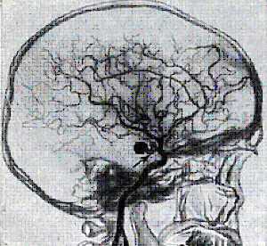 Аневризма судин головного мозку: симптоми, лікування, операції при аневризмі