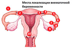 Біль в лівому боці внизу живота у жінок і чоловіків - причини, діагностика