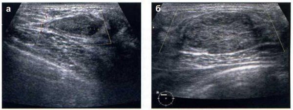 Фиброзирующий аденоз молочної залози: що це таке, УЗД картинка і рентген, лікування