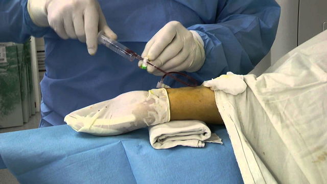 Операція коронарного шунтування судин серця: показання та відновлення після операції