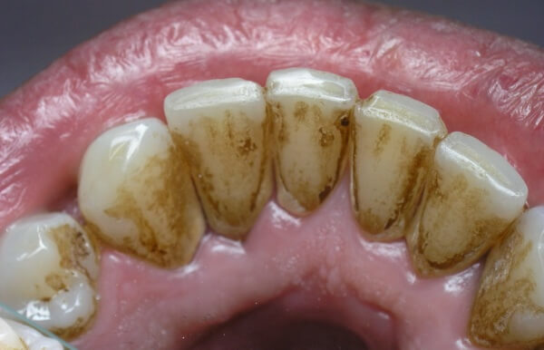 Зубний камінь: як виглядає, як видалити, як позбутися в домашніх умовах