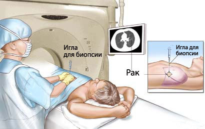 Як роблять біопсію: порядок взяття біопсії для виявлення раку, розшифровка біопсії.