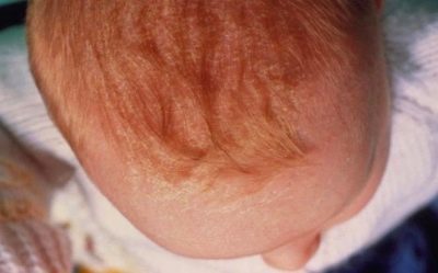 Себорейний дерматит у немовляти: як прибрати скоринки на голові у дитини