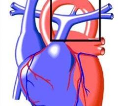 Відкрите овальне вікно в серце: причини розвитку, характерні симптоми, діагностика та тактика лікування