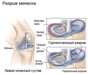 Дегенеративні зміни менісків колінного суглоба: симптоми і лікування