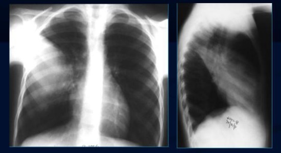 Рентген і флюорографія легень - свідчення, правила проведення та розшифровки результатів.