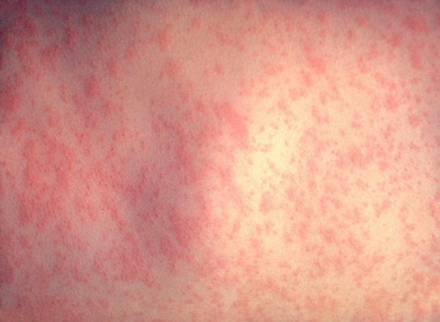Холодова алергія - симптоми і лікування народними засобами