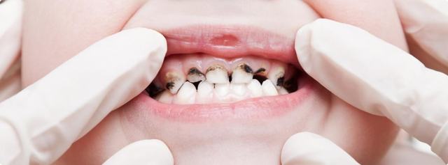 Чому темніють зуби у дорослих: причини потемніння зубної емалі і методи відбілювання зубів