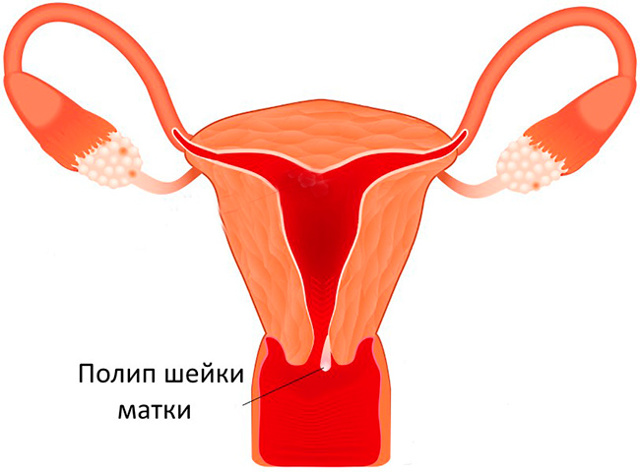 Поліпи шийки матки - симптоми, лікування і профілактика