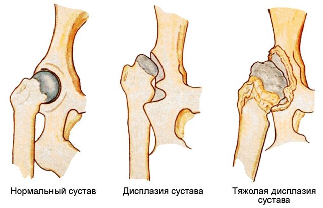 Дисплазія тазостегнових суглобів у дітей: симптоми, причини розвитку, лікування дисплазії ТБС, масаж і гімнастика при дисплазії тазостегнових суглобів  