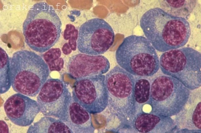 Множинна мієлома крові: чи можна вилікуватися, прогноз, лікування плазмоцитоми