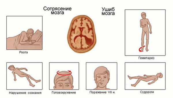 Черепно-мозкова травма: симптоми, класифікація, перша допомога, наслідки