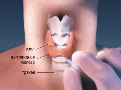Ознаки захворювань щитовидної залози: перелік поширених симптомів захворювань щитовидної залози