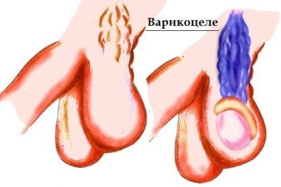 Варикоцеле - симптоми, причини розвитку, ступеня варикоцеле і методи лікування.