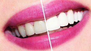 Профессиональное отбеливание зубов системой beyond polus: плюсы и минусы