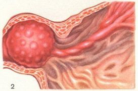 Доброякісні пухлини шлунка: причини розвитку, клінічні ознаки, принципи лікування та можливі ускладнення