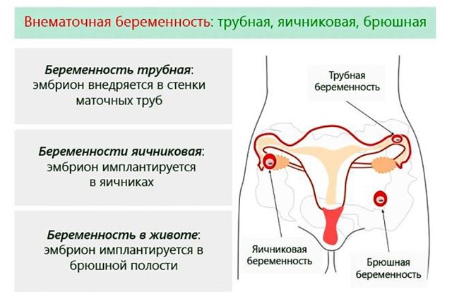 Трубна вагітність (ектопічної): ознаки порушень