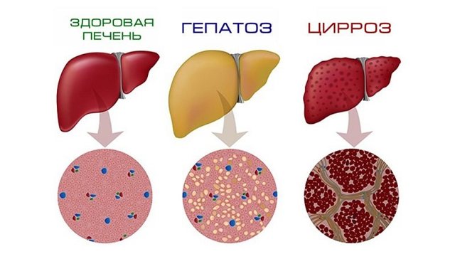 Гепатоз: симптоми і лікування, народне лікування гепатозу, дієта при жировий гепатоз печінки