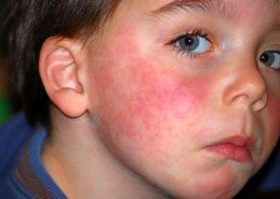 Алергія на яйця: симптоми у дорослих і дітей, методи діагностики і лікування