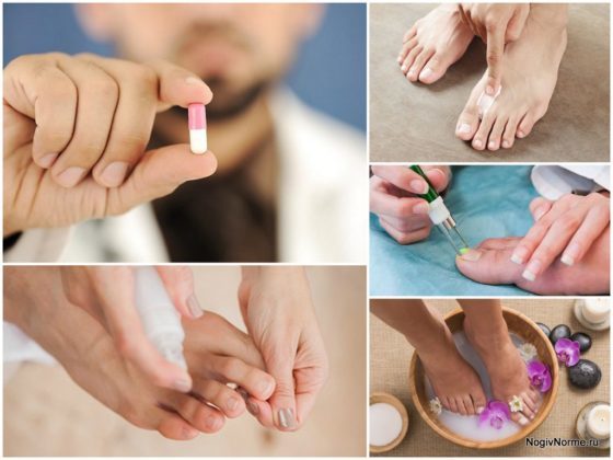 Мікоз нігтів: лікування, таблетки від грибка нігтів, ламізил, флуконазол, клотримазол, екзодеріл і лоцерил при грибку нігтів