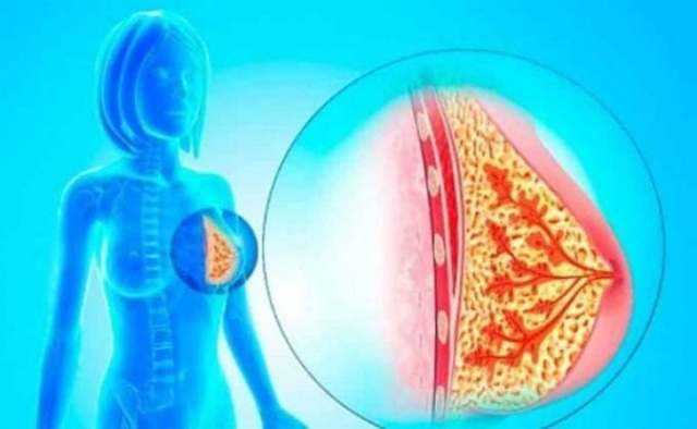 Папіломи під грудними залозами: симптоми внутрипротокового папилломатоза