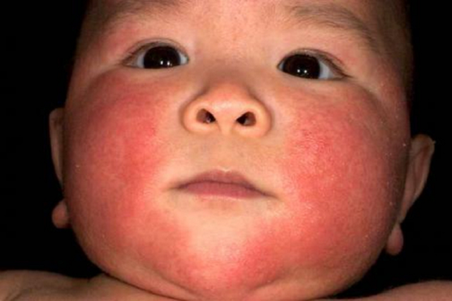 Чому у дитини з'явилися червоні плями на тілі?