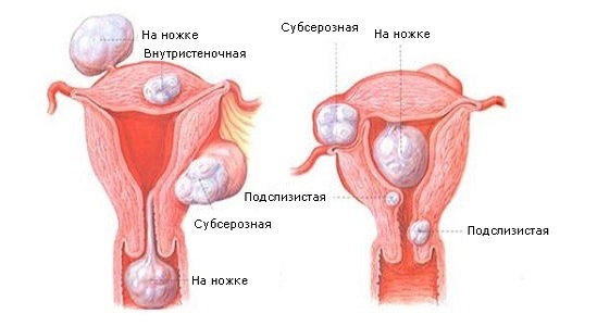 Фіброміома матки: що це таке і чи небезпечна, симптоми і ознаки, операція