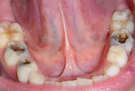 Дентаплюс краплі зубні: склад, показання інструкція із застосування