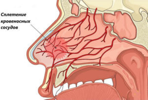 Як зміцнити судини носа при частих кровотечах?