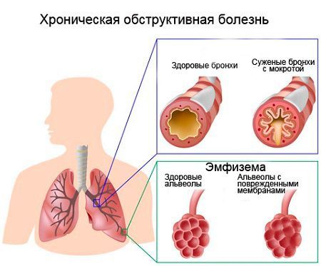 Обструкція дихальних шляхів: причини, класифікація та лікування