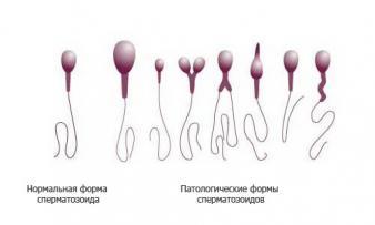 Види патологій сперми і лікування чоловічого безпліддя: нові методики і можливості репродуктивної медицини 