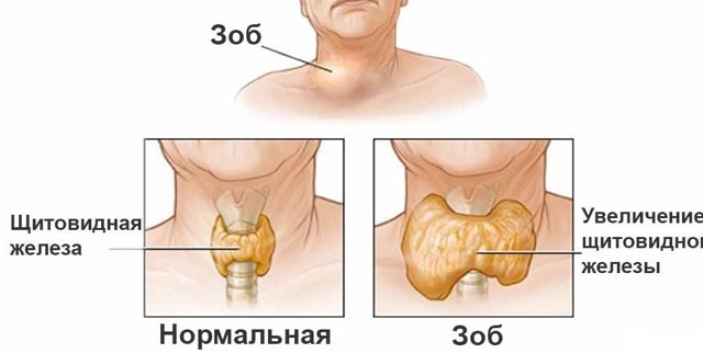 Вузловий зоб щитовидної залози - симптоми і лікування, діагностика зоба