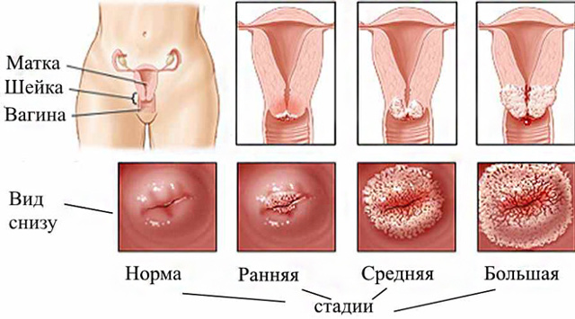 Ерозія шийки матки у жінок: причини виникнення, симптоми, лікування і наслідки