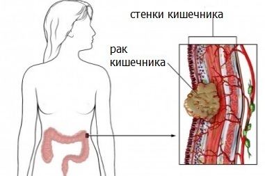Болі в кишечнику: причини, лікування, до якого лікаря звертатися при болю в кишечнику